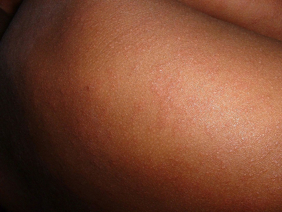 Infectious Diseases – Measles (In the Vaccinated).